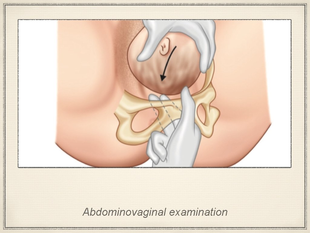 Abdominovaginal examination 
