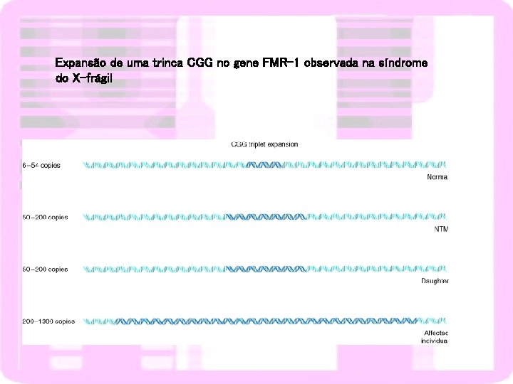 Expansão de uma trinca CGG no gene FMR-1 observada na síndrome do X-frágil 