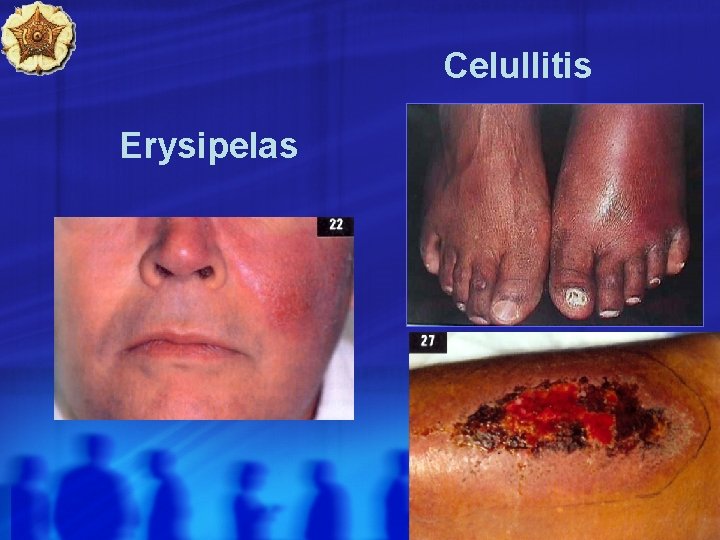 Celullitis Erysipelas 11 