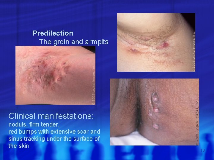 Predilection The groin and armpits Clinical manifestations: noduls, firm tender, red bumps with extensive