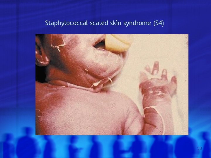 Staphylococcal scaled skin syndrome (S 4) 20 
