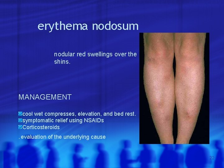 erythema nodosum nodular red swellings over the shins. MANAGEMENT cool wet compresses, elevation, and