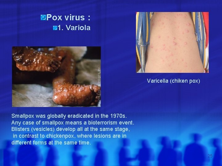 Pox virus : 1. Variola Varicella (chiken pox) Smallpox was globally eradicated in the