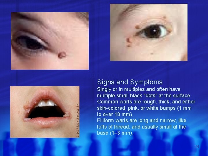 Thank you Signs and Symptoms Singly or in multiples and often have multiple small
