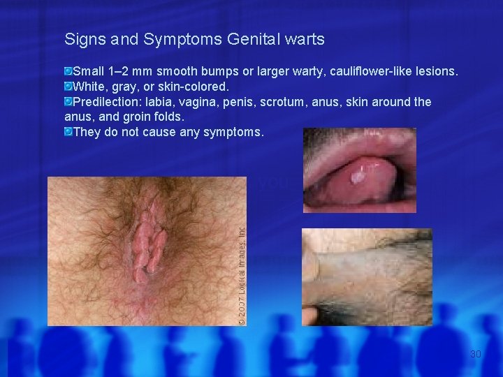 Signs and Symptoms Genital warts Small 1– 2 mm smooth bumps or larger warty,