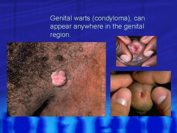 Genital warts (condyloma), can appear anywhere in the genital region. Thank you 31 