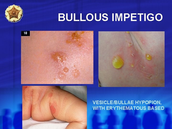 BULLOUS IMPETIGO VESICLE/BULLAE HYPOPION, WITH ERYTHEMATOUS BASED 7 