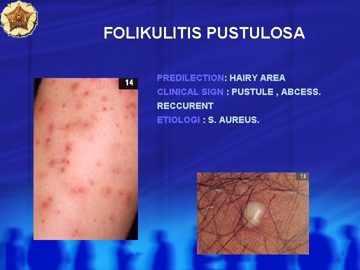 FOLIKULITIS PUSTULOSA PREDILECTION: HAIRY AREA CLINICAL SIGN : PUSTULE , ABCESS. RECCURENT ETIOLOGI :