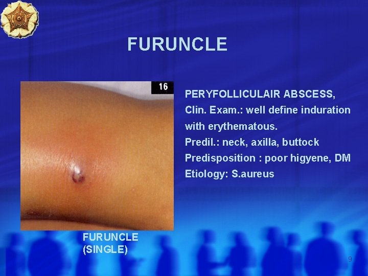 FURUNCLE PERYFOLLICULAIR ABSCESS, Clin. Exam. : well define induration with erythematous. Predil. : neck,