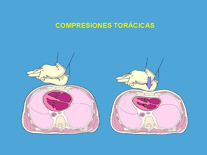 COMPRESIONES TORÁCICAS 