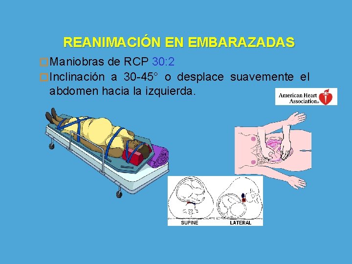 REANIMACIÓN EN EMBARAZADAS � Maniobras de RCP 30: 2 � Inclinación a 30 -45°