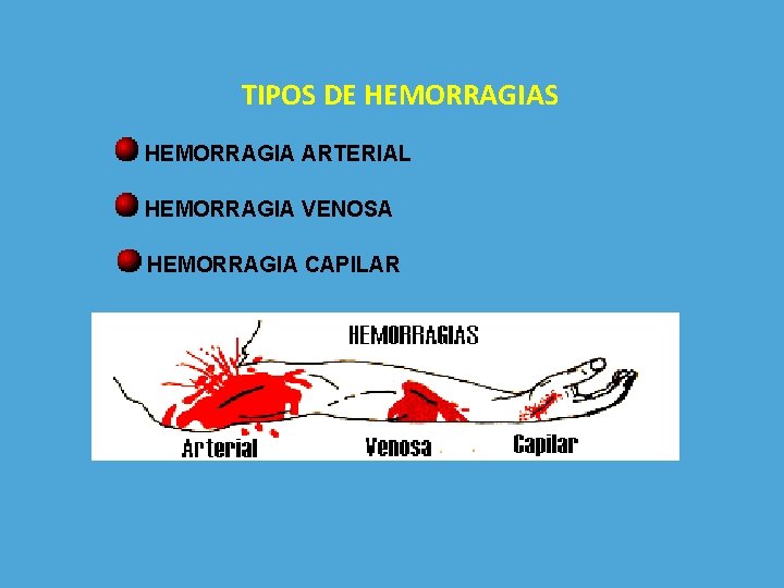 TIPOS DE HEMORRAGIAS HEMORRAGIA ARTERIAL HEMORRAGIA VENOSA HEMORRAGIA CAPILAR 