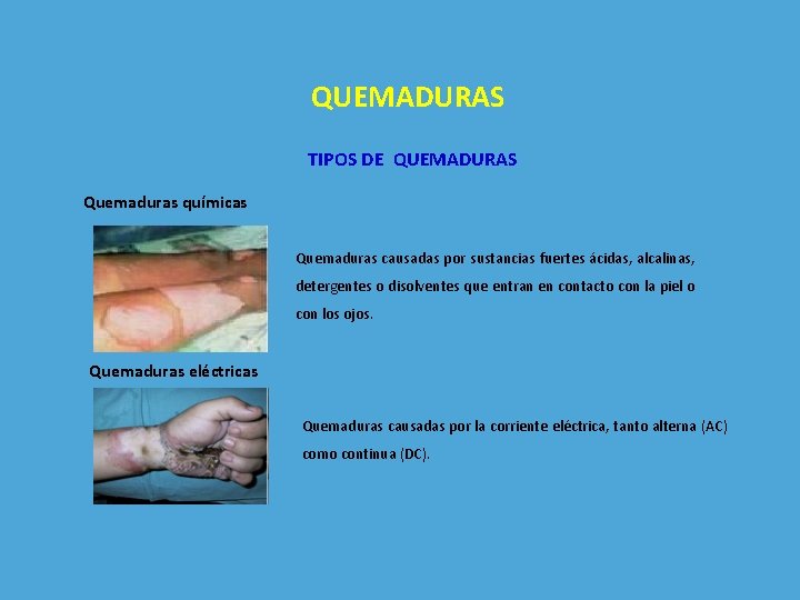 QUEMADURAS TIPOS DE QUEMADURAS Quemaduras químicas Quemaduras causadas por sustancias fuertes ácidas, alcalinas, detergentes