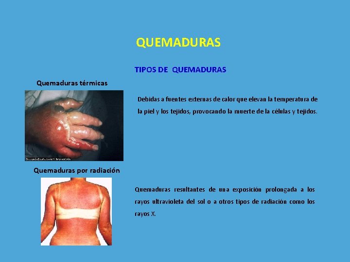 QUEMADURAS TIPOS DE QUEMADURAS Quemaduras térmicas Debidas a fuentes externas de calor que elevan