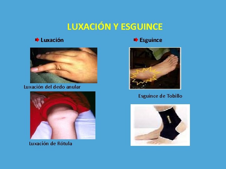 LUXACIÓN Y ESGUINCE Luxación Esguince Luxación del dedo anular Esguince de Tobillo Luxación de