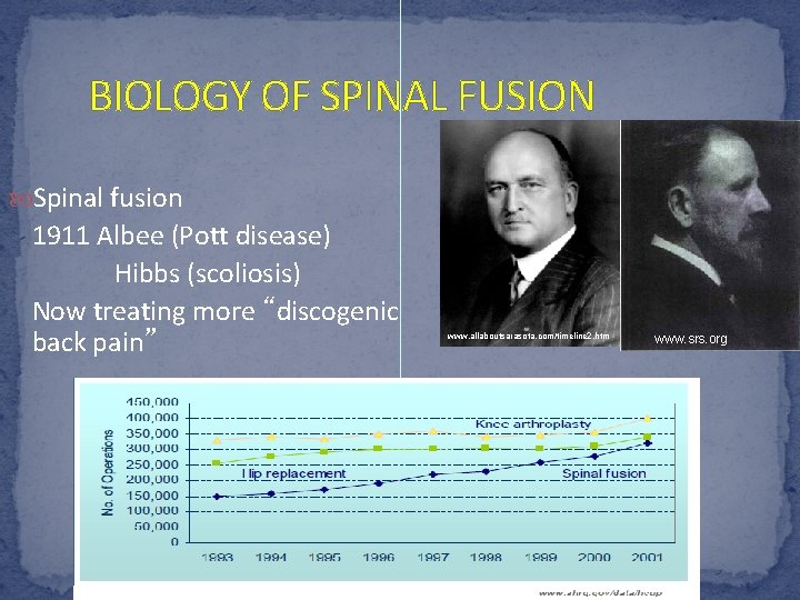 BIOLOGY OF SPINAL FUSION Spinal fusion 1911 Albee (Pott disease) Hibbs (scoliosis) Now treating
