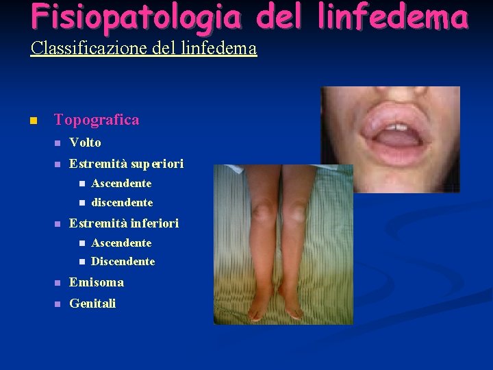 Fisiopatologia del linfedema Classificazione del linfedema Topografica Volto Estremità superiori Ascendente discendente Estremità inferiori