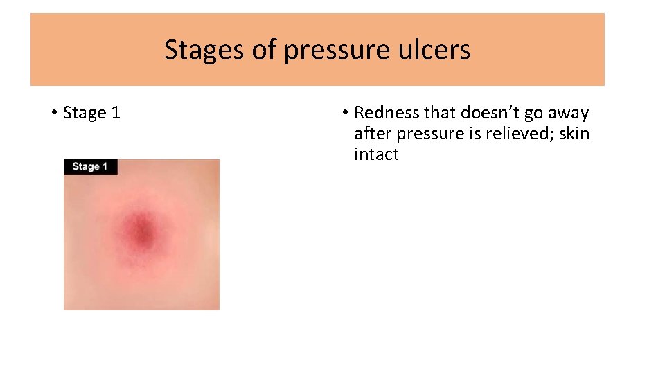 Stages of pressure ulcers • Stage 1 • Redness that doesn’t go away after
