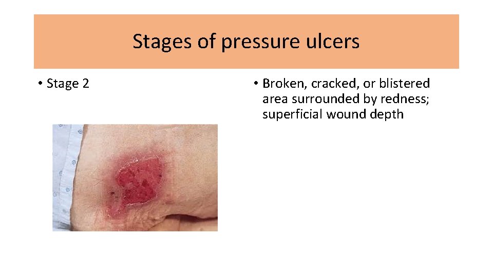 Stages of pressure ulcers • Stage 2 • Broken, cracked, or blistered area surrounded