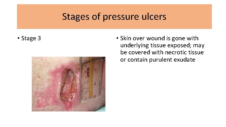 Stages of pressure ulcers • Stage 3 • Skin over wound is gone with