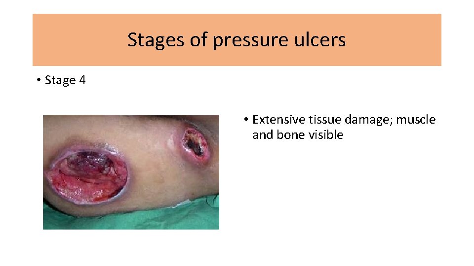Stages of pressure ulcers • Stage 4 • Extensive tissue damage; muscle and bone