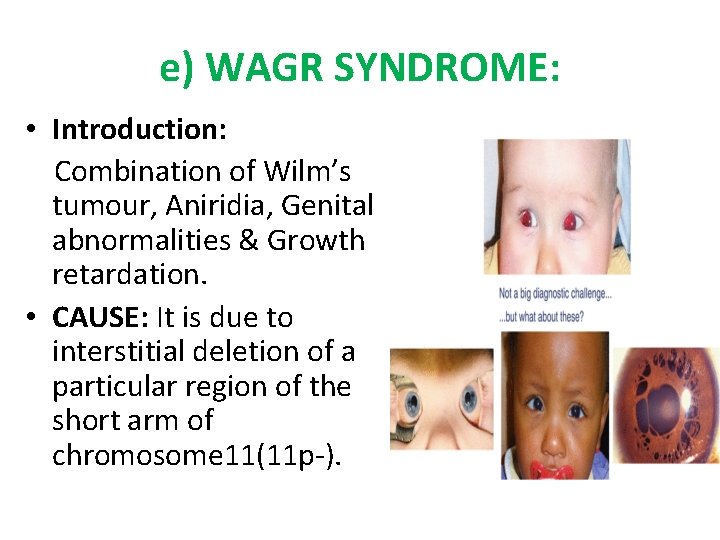 e) WAGR SYNDROME: • Introduction: Combination of Wilm’s tumour, Aniridia, Genital abnormalities & Growth