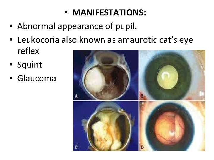  • • • MANIFESTATIONS: Abnormal appearance of pupil. Leukocoria also known as amaurotic
