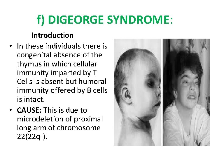 f) DIGEORGE SYNDROME: Introduction • In these individuals there is congenital absence of the