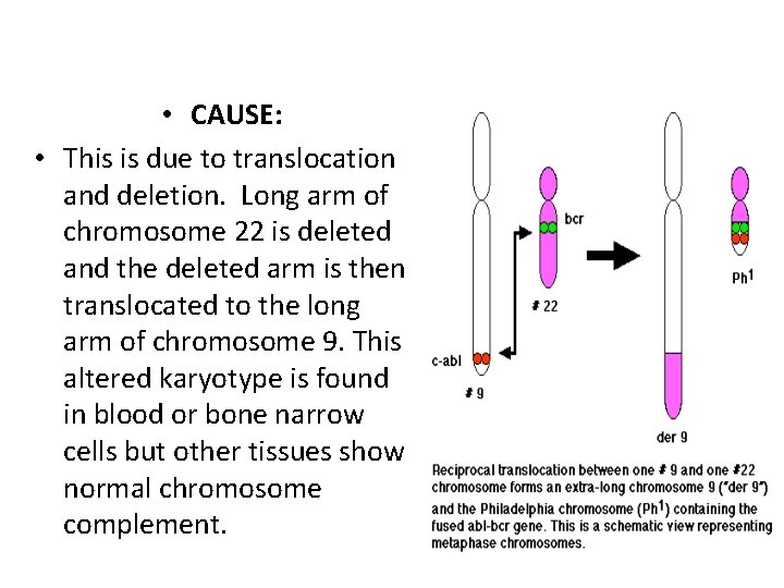  • CAUSE: • This is due to translocation and deletion. Long arm of