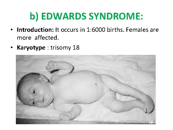 b) EDWARDS SYNDROME: • Introduction: It occurs in 1: 6000 births. Females are more