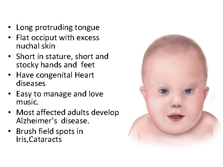  • Long protruding tongue • Flat occiput with excess nuchal skin • Short