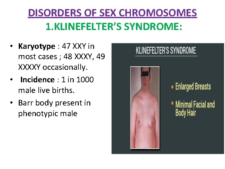 DISORDERS OF SEX CHROMOSOMES 1. KLINEFELTER’S SYNDROME: • Karyotype : 47 XXY in most