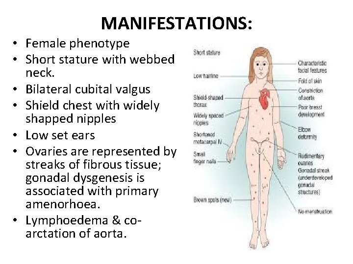 MANIFESTATIONS: • Female phenotype • Short stature with webbed neck. • Bilateral cubital valgus