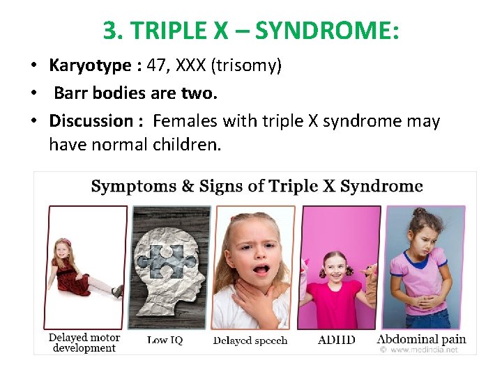 3. TRIPLE X – SYNDROME: • Karyotype : 47, XXX (trisomy) • Barr bodies