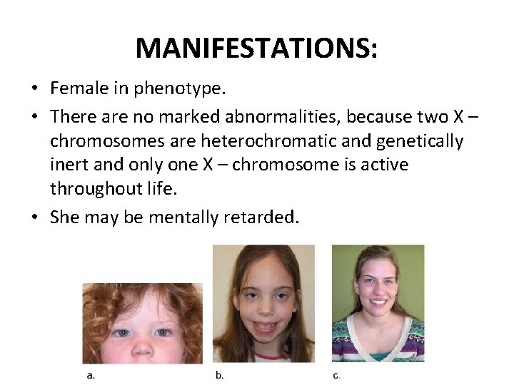 MANIFESTATIONS: • Female in phenotype. • There are no marked abnormalities, because two X