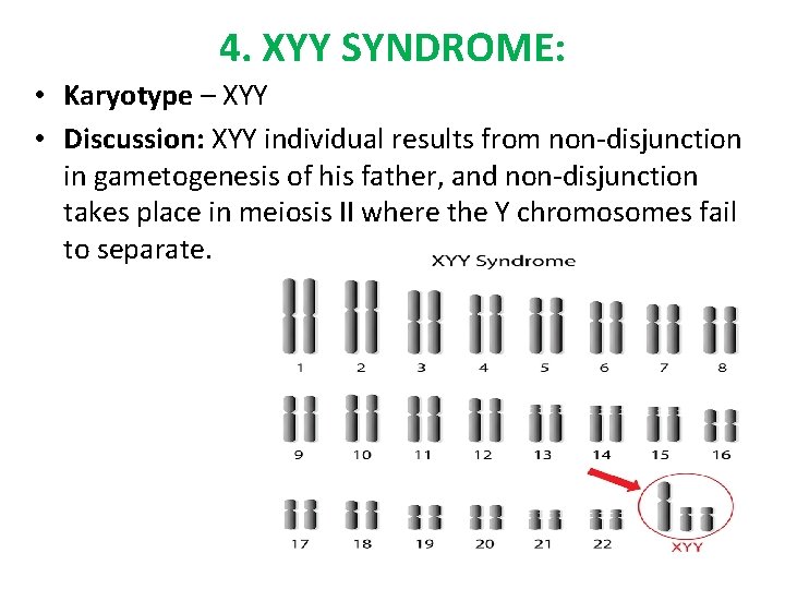 4. XYY SYNDROME: • Karyotype – XYY • Discussion: XYY individual results from non-disjunction