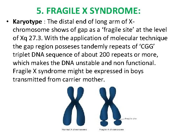 5. FRAGILE X SYNDROME: • Karyotype : The distal end of long arm of