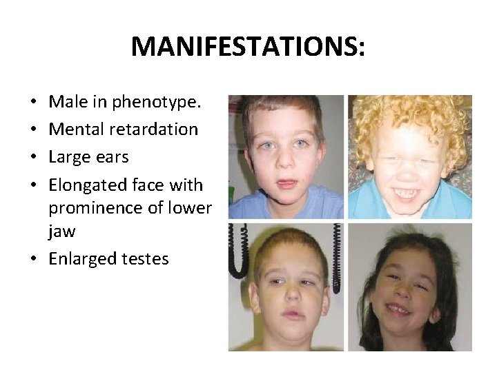 MANIFESTATIONS: Male in phenotype. Mental retardation Large ears Elongated face with prominence of lower