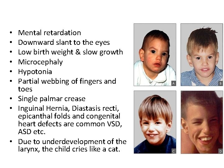 Mental retardation Downward slant to the eyes Low birth weight & slow growth Microcephaly