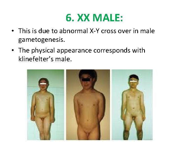 6. XX MALE: • This is due to abnormal X-Y cross over in male