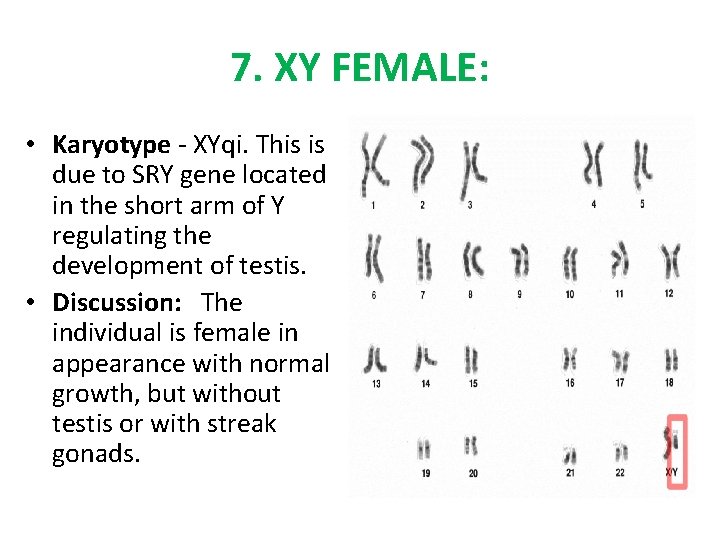 7. XY FEMALE: • Karyotype - XYqi. This is due to SRY gene located