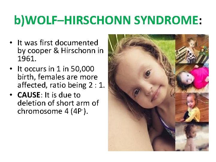 b)WOLF–HIRSCHONN SYNDROME: • It was first documented by cooper & Hirschonn in 1961. •