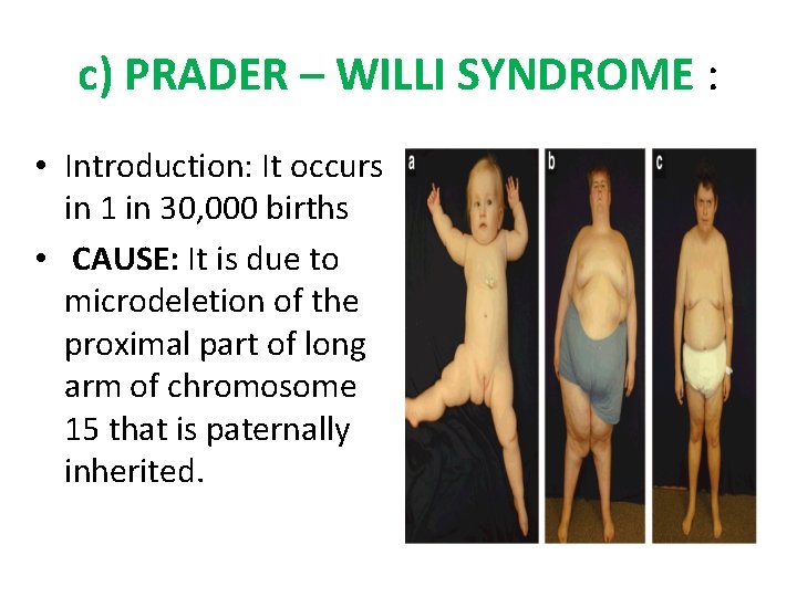 c) PRADER – WILLI SYNDROME : • Introduction: It occurs in 1 in 30,