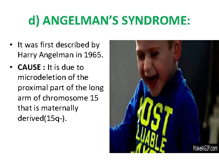 d) ANGELMAN’S SYNDROME: • It was first described by Harry Angelman in 1965. •