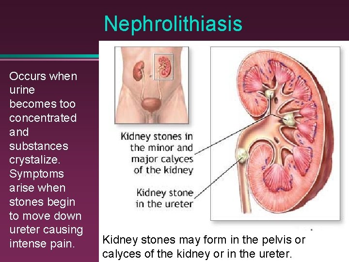 Nephrolithiasis Occurs when urine becomes too concentrated and substances crystalize. Symptoms arise when stones