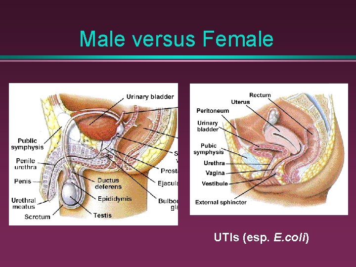 Male versus Female UTIs (esp. E. coli) 