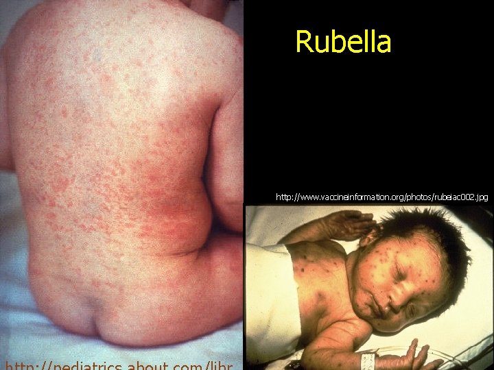 Rubella http: //www. vaccineinformation. org/photos/rubeiac 002. jpg 