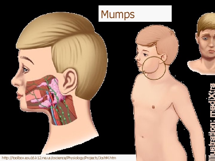 Mumps http: //toolbox. esu 16. k 12. ne. us/oscience/Physiology/Projects/Josh. M. htm 