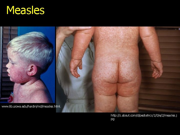 Measles www. lib. uiowa. edu/hardin/md/measles. html. http: //z. about. com/d/pediatrics/1/0/e/2/measles. j pg 
