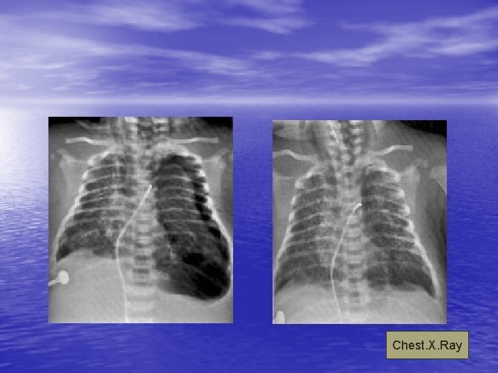 Chest. X. Ray 